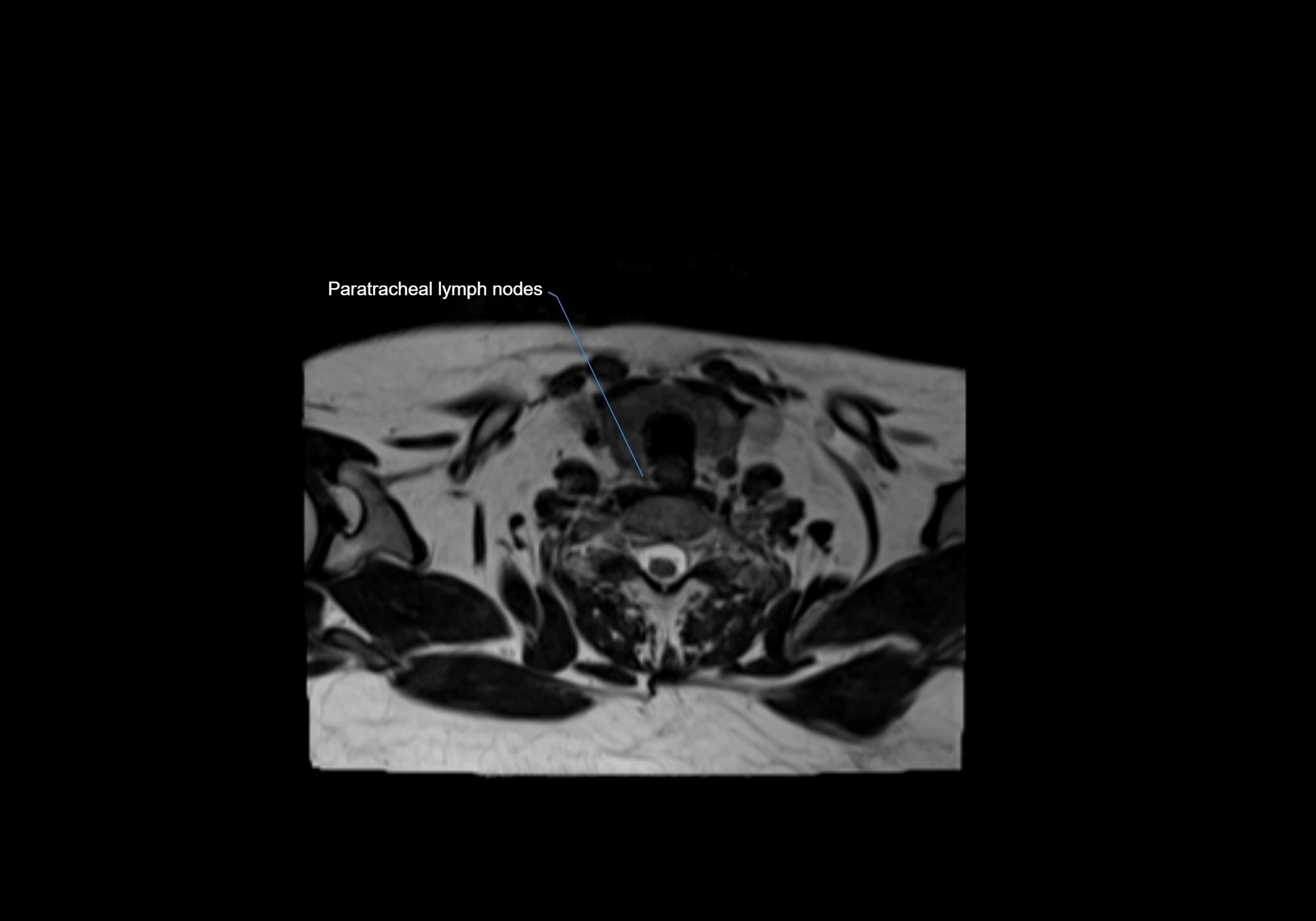 Neck axial  lymph node cross sectional MRI anatomy 3T MRI  image-img-00001-00083.webp